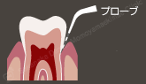 プローブ